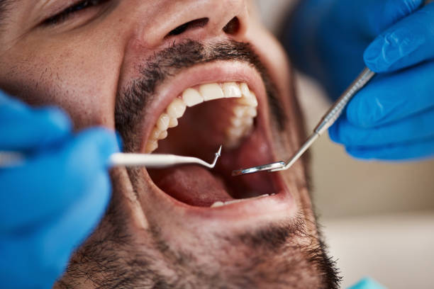 Best Dental Abscess Treatment in Marion, AL
