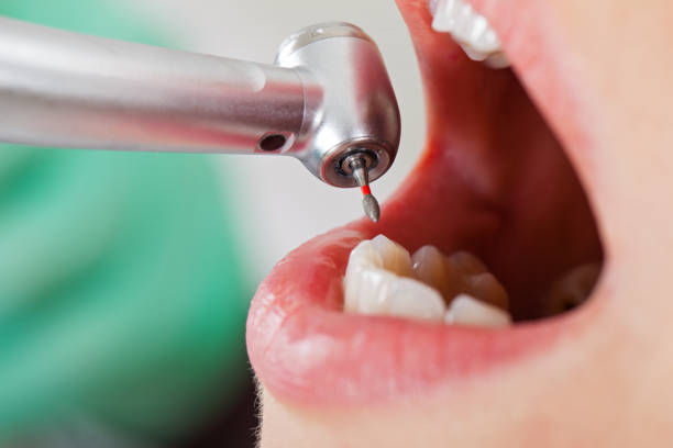 Best Broken or Chipped Tooth Repair in Marion, AL